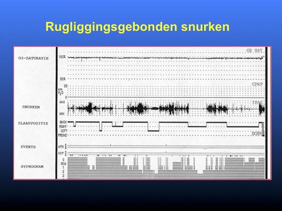 Slaappositie en apneu